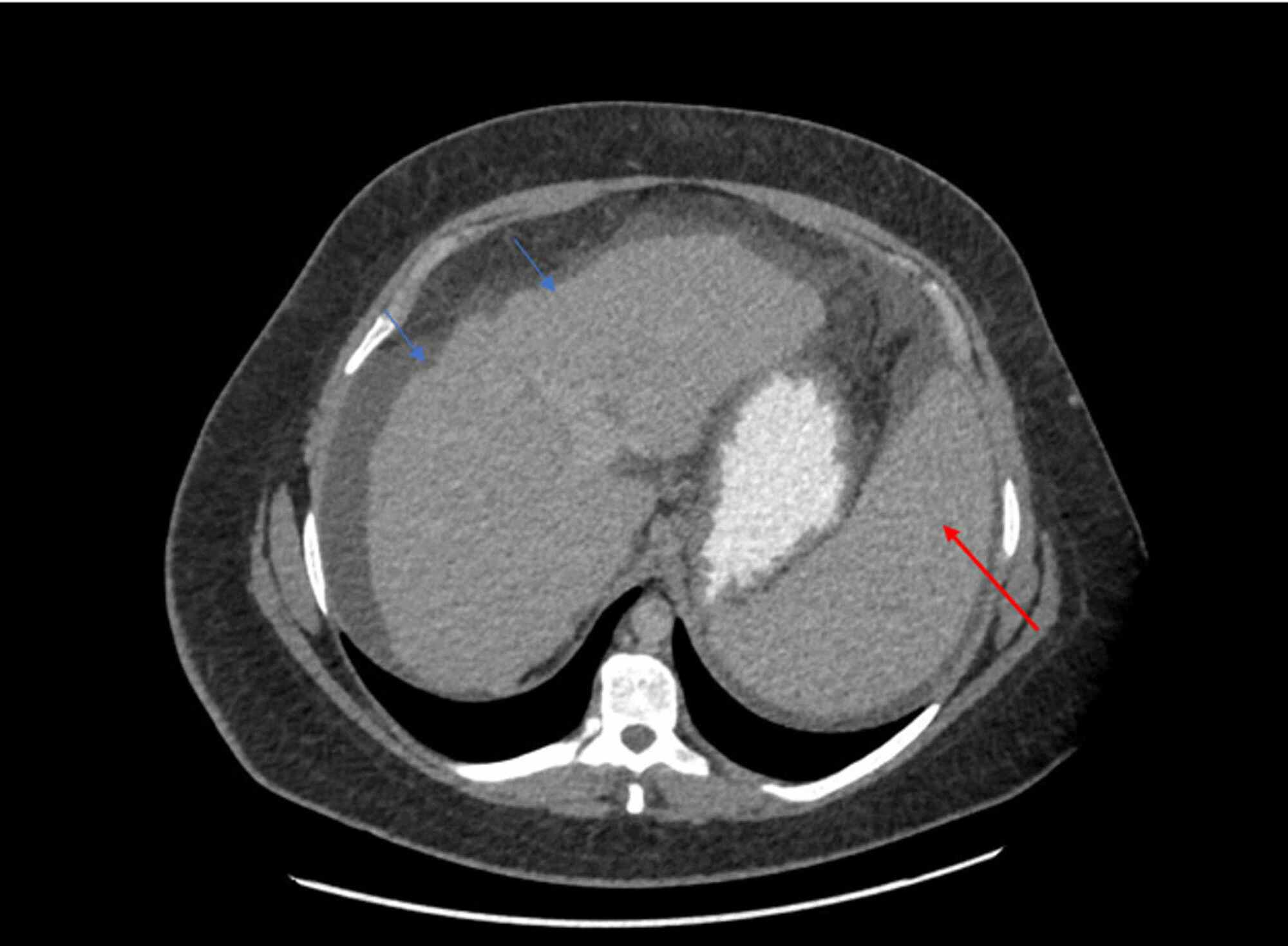 Cureus Liver Cirrhosis Secondary to Autoimmune Hepatitis in a Patient