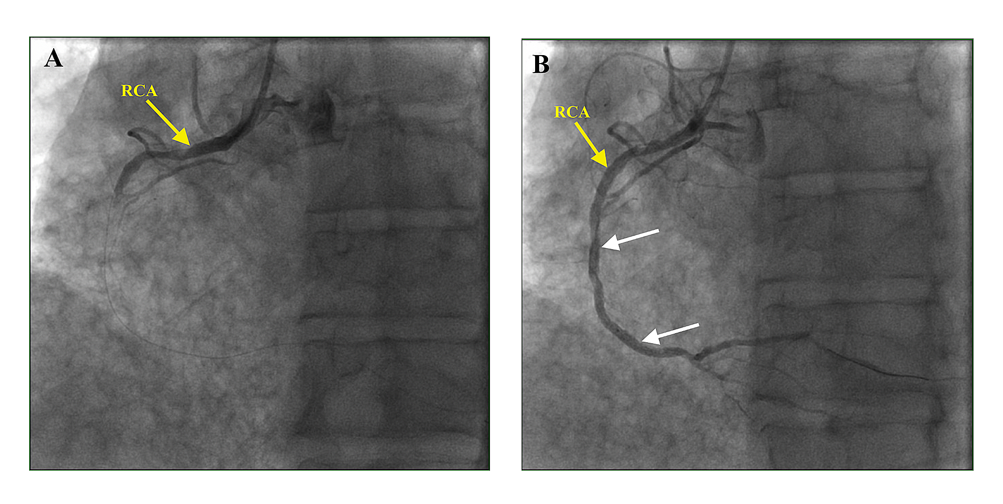 Cureus | An Unusual Case of ST Elevation Myocardial Infarction in