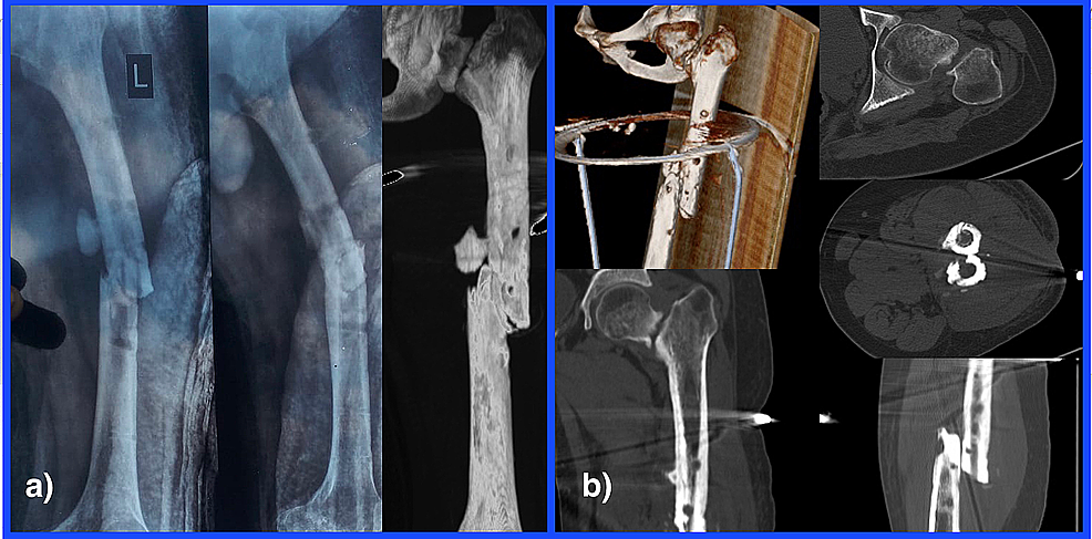 Non-union-of-the-ipsilateral-neck-of-femur-and-shaft-of-femur-left-side.-a)-Preoperative-radiographs-reveal-non-union-of-shaft-femur-fracture-without-any-evidence-of-healing.-The-neck-of-the-femur-radiograph-reveals-sclerotic-and-smooth-margins-along-with-the-gap-at-the-fracture-site.-b)-the-computed-tomography-2D-and-3D-images-confirm-the-findings-of-atrophic-non-union-of-the-shaft-of-femur-and-neck-of-femur.