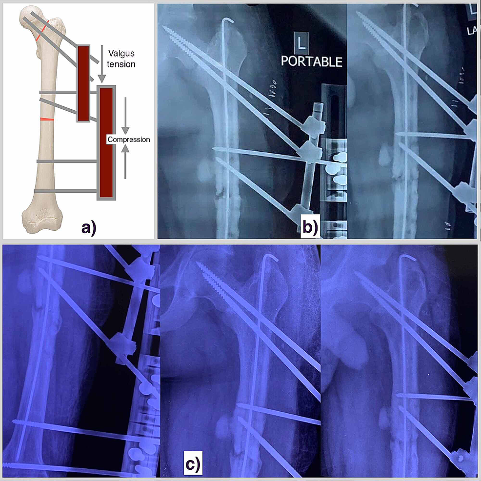 a)-A-representation-image-showing-the-external-fixator-assembly-for-the-stabilization-of-the-femoral-neck-as-well-as-femoral-shaft-non-union.-b)-The-6-weeks-post-operative-radiograph-(-post-cement-bead-removal)-of-the-left-side-femoral-shaft-and-hip-region-suggestive-of-maintained-fracture-alignment-of-both-the-regions.-c)-The-3-months-post-operative-radiograph-showing-bridging-bone-formation-at-the-femoral-shaft-nonunion-site,-while-the-union-status-of-femoral-neck-can't-be-commented-upon.