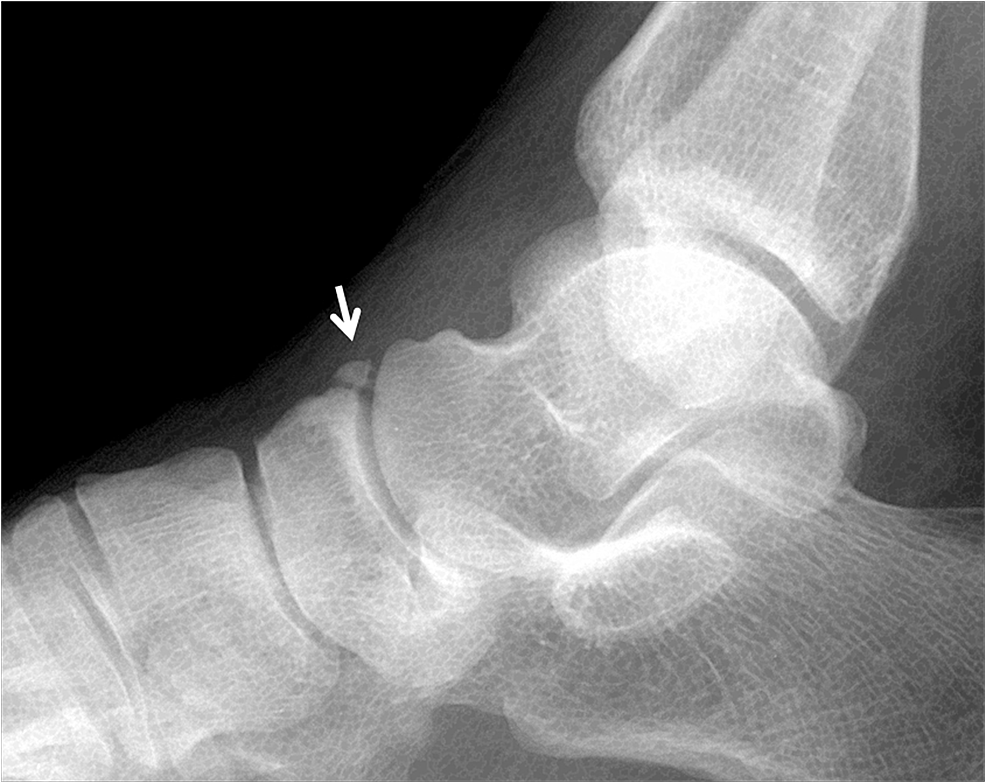 Cureus | Accessory Ossicles of the Foot and Ankle: Disorders and a ...