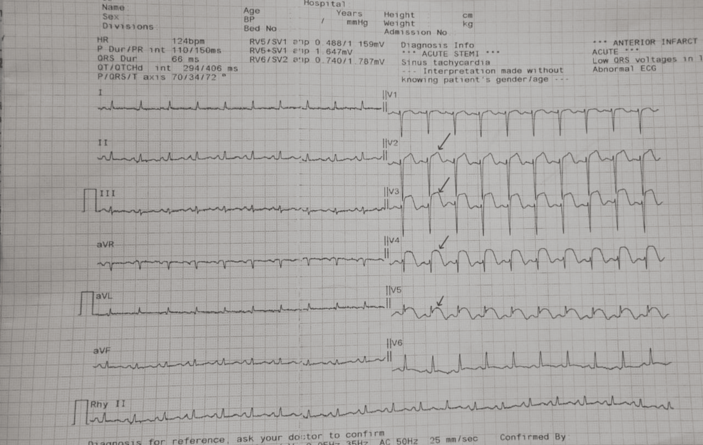 Revascularisation rapide et traitement par anticoagulants oraux sans vitamine K (NOAC) entraînant la résolution du thrombus apical ventriculaire gauche chez une jeune femme présentant un infarctus du myocarde avec élévation du ST de l’artère descendante antérieure gauche sans moignon (LAD STEMI)