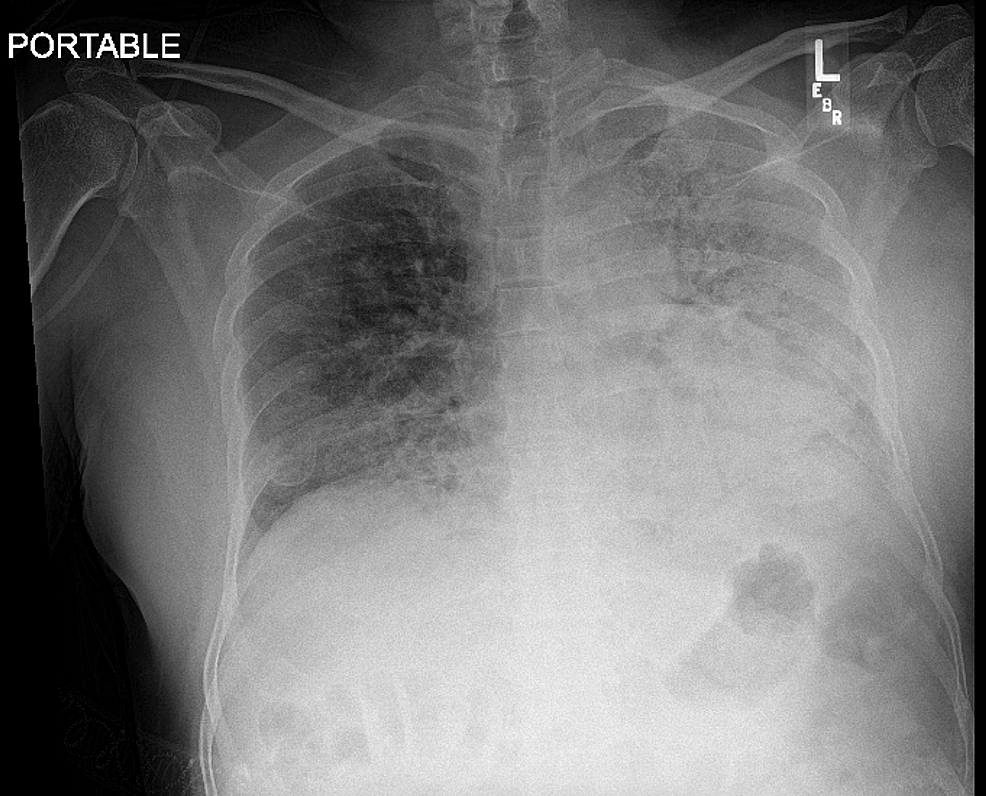 COVID-19 Induced Bilateral Lower Limb Ischemia and Visceral Infarcts ...