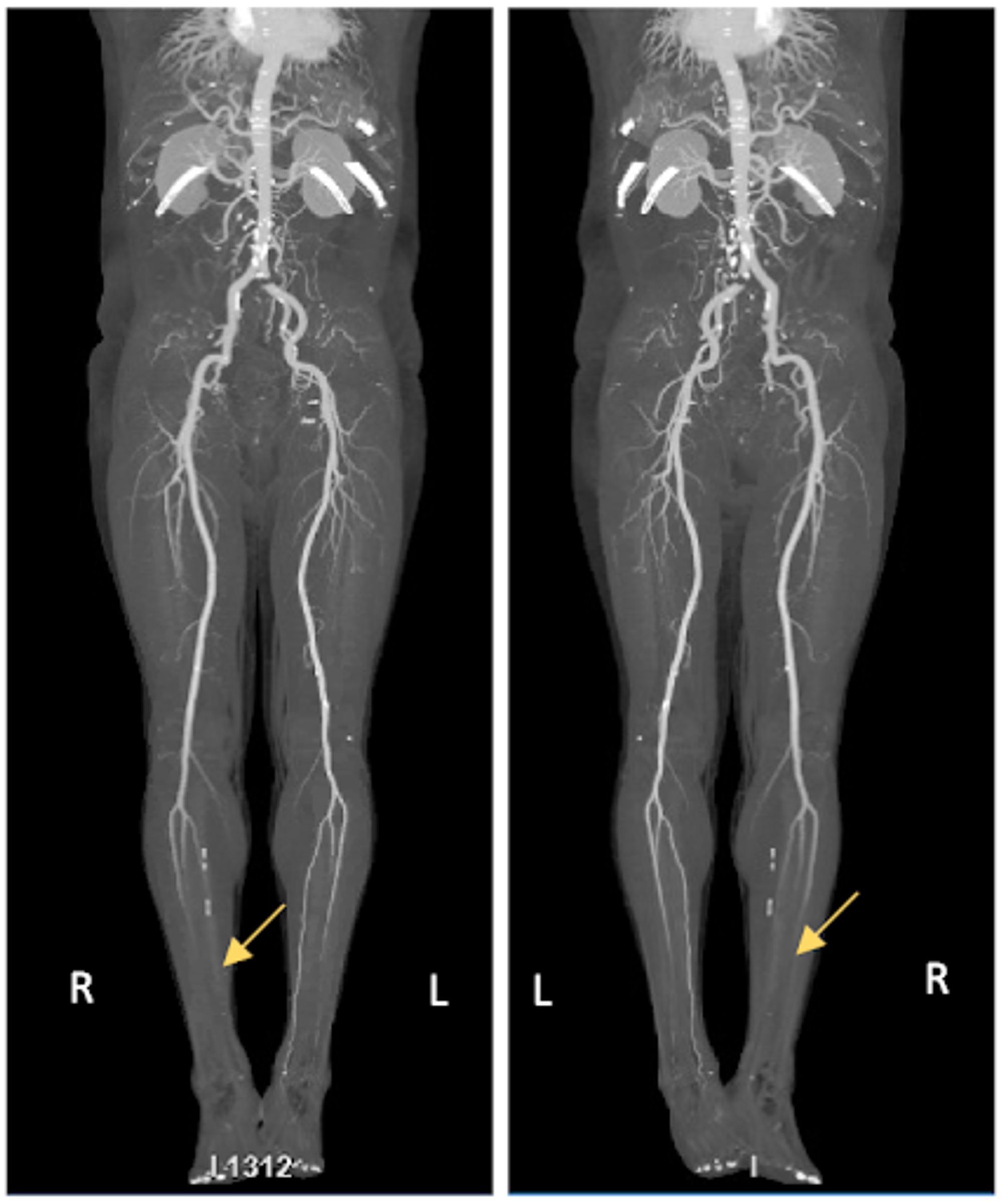 cureus-covid-19-induced-bilateral-lower-limb-ischemia-and-visceral