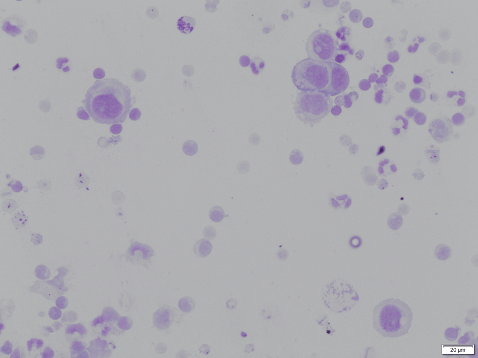 Peritoneal Tuberculosis Mimicking Pseudomyxoma Peritonei: A Diagnostic Challenge