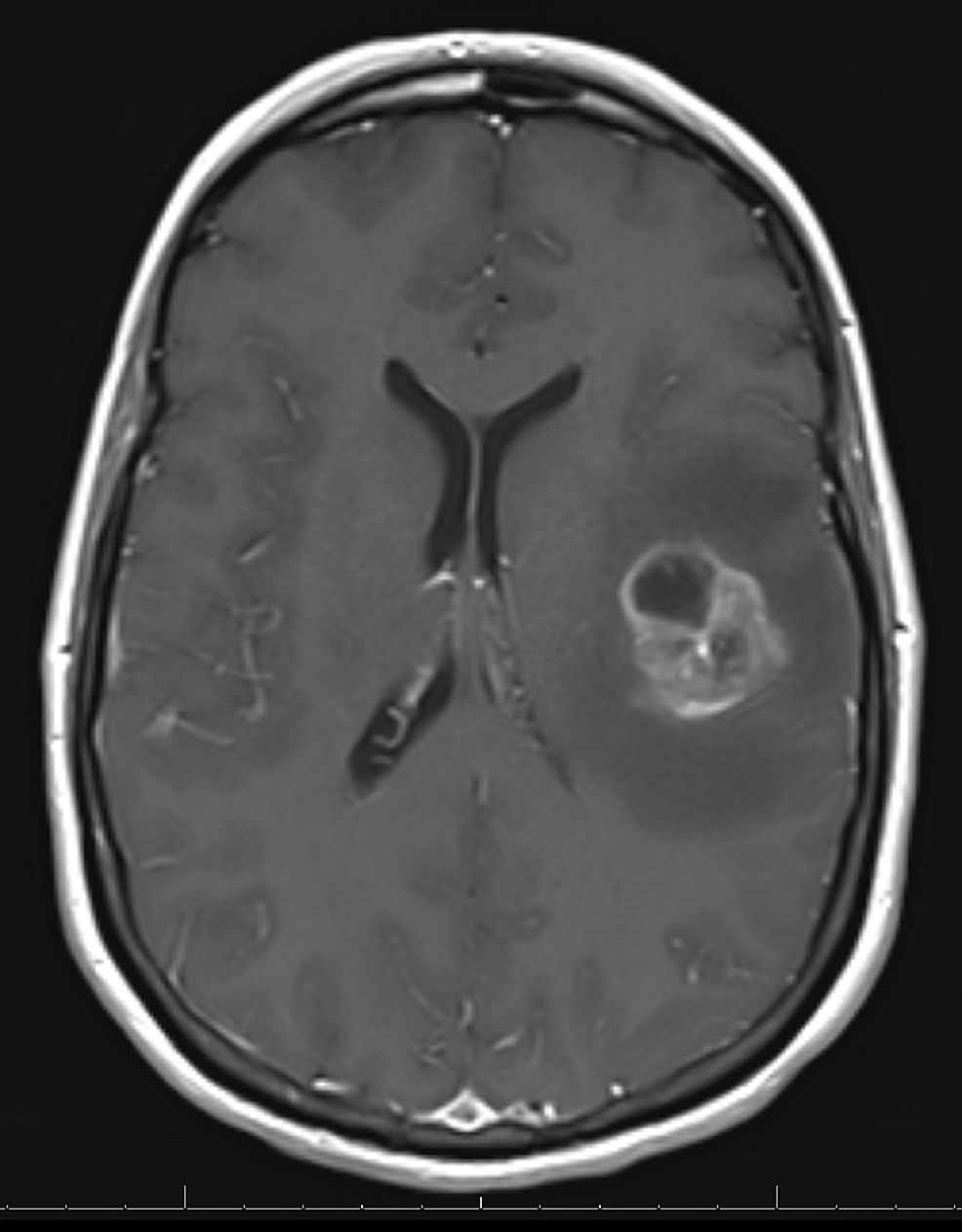 Magnetic-resonance-imaging-(MRI)-showing-solitary-metastasis-in-the-left-frontal-lobe
