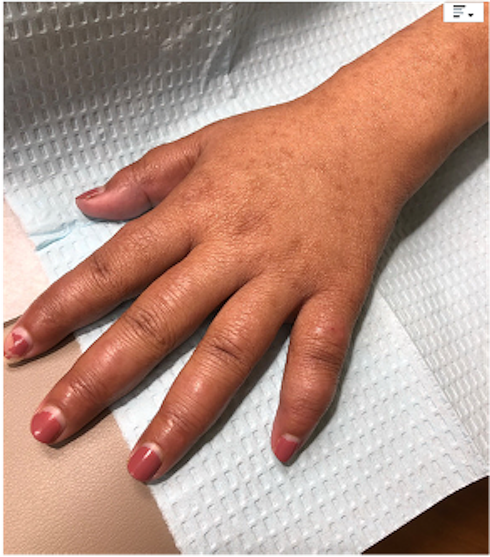 Cureus Chronic Hand Swelling and Dactylitis in Leprosy A Case Report