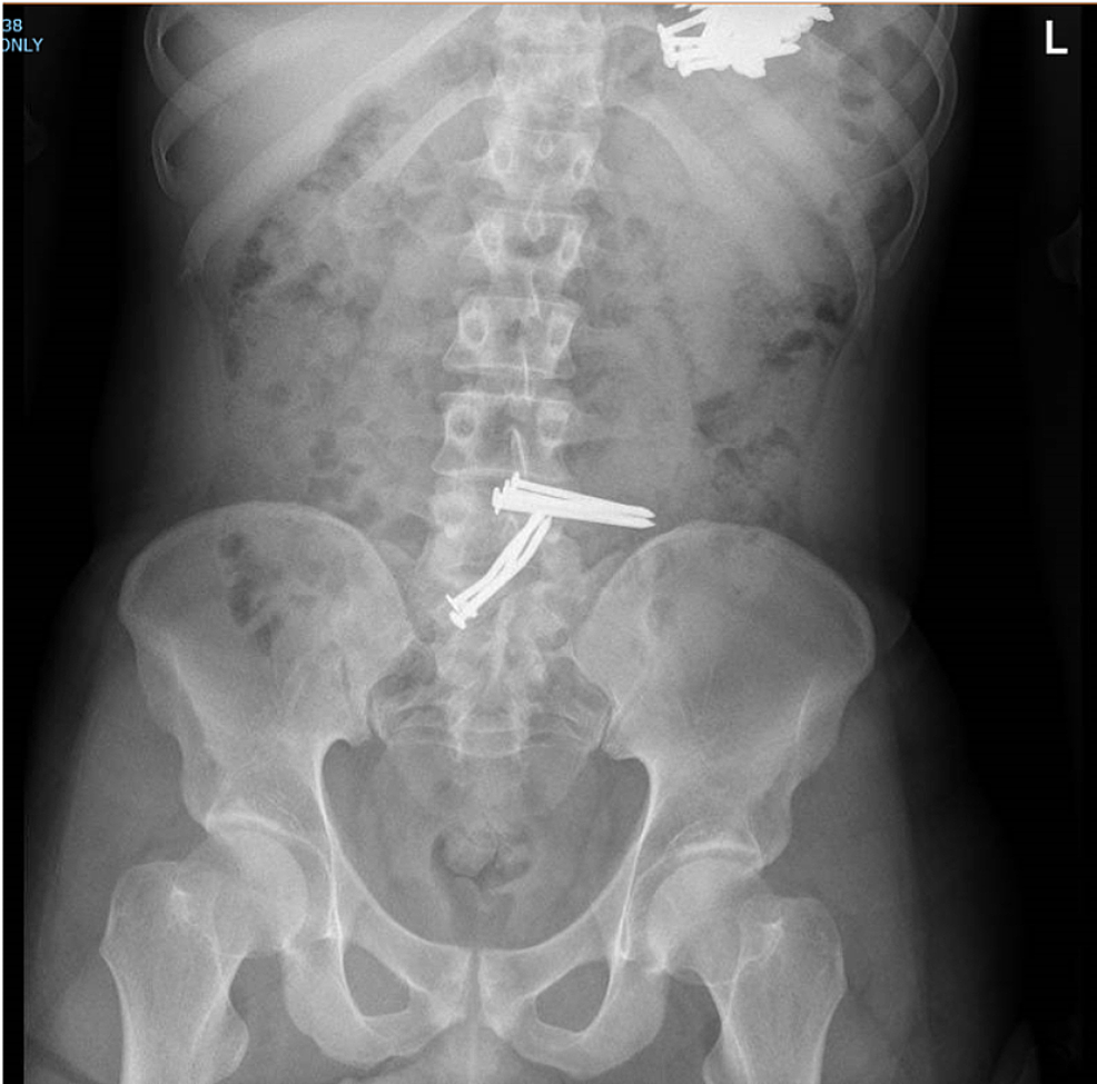 Cureus | Surgical Management of Massive Metal Bezoar