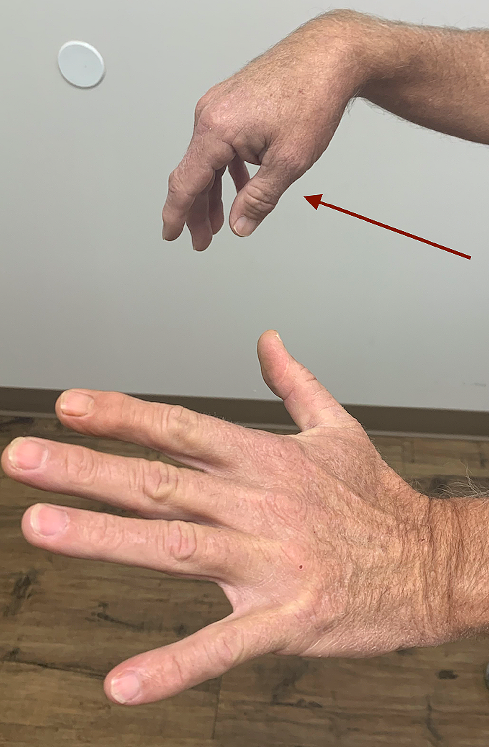 Right-wrist,-finger,-and-thumb-drop-(red-arrow)