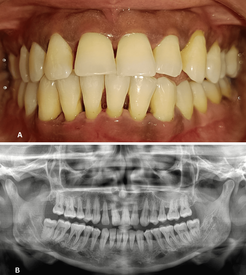 Effet du traitement parodontal non chirurgical sur les niveaux de ghréline et de facteur de nécrose tumorale alpha (TNF-α) dans le liquide gingival creviculaire de patients sains et atteints de parodontite avec et sans diabète sucré de type 2 : une étude clinico-biochimique