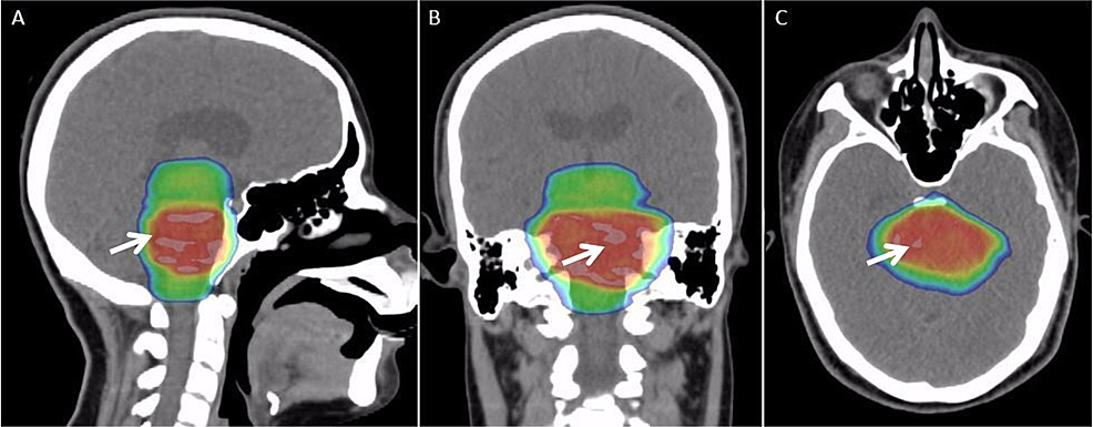 Treatment-plan-for-a-16-year-old-female-with-a-diffuse-intrinsic-pontine-glioma