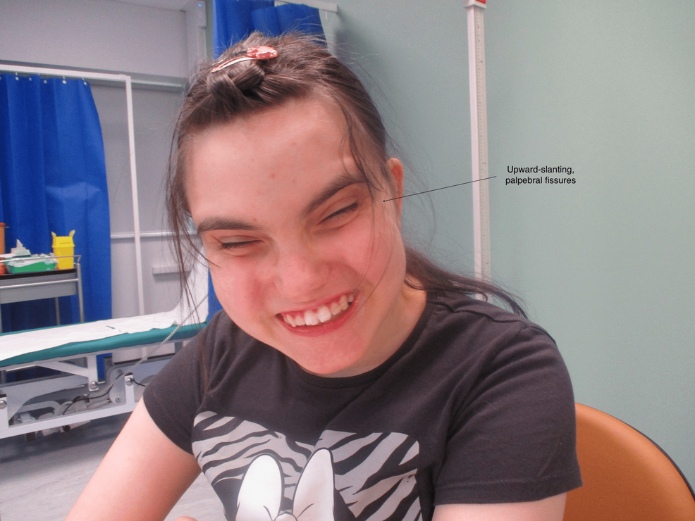 A Rare Case of Coexisting 22q11.2 Deletion Syndrome and Cornelia De Lange Syndrome: A Case Report and Review of the Literature