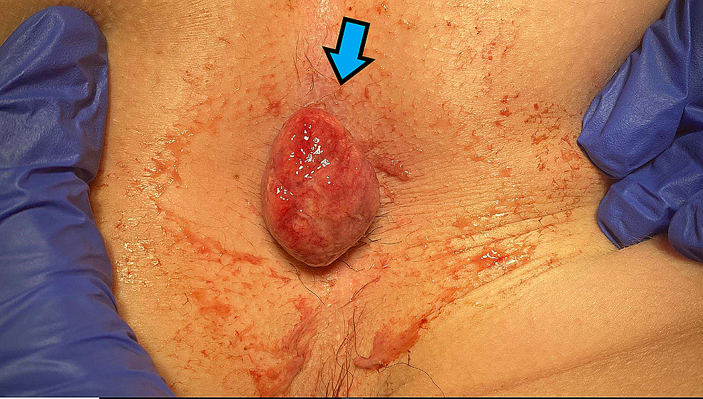 The proper management of a prolapsed rectal mass in a child or teenager is challenging. Given that the underlying etiology of a prolapsed rectal mass in this population is not always immediately clear, interdisciplinary assessment is often required. Juvenile polyps, more commonly presenting with bleeding than a prolapsed mass, can mimic the appearance of both hemorrhoids and the rectum itself - making a purely clinical diagnosis difficult. Presented here is a case of a prolapsed colorectal polyp in a teenage boy, who underwent manual reduction of the mass, followed by colonoscopy and endoscopic ligation. Further histological evaluation revealed it to be a juvenile retention polyp. Despite the rarity of polyp prolapse as a presenting symptom, this case underscores the importance of considering colonic polyps as the etiology of a prolapsed anorectal mass in a teenager.