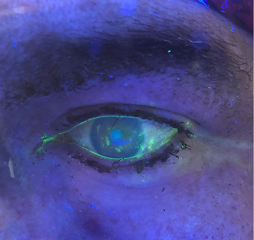 Cureus Flash Burn of the Eyes Caused by HighVoltage Electrical Spark