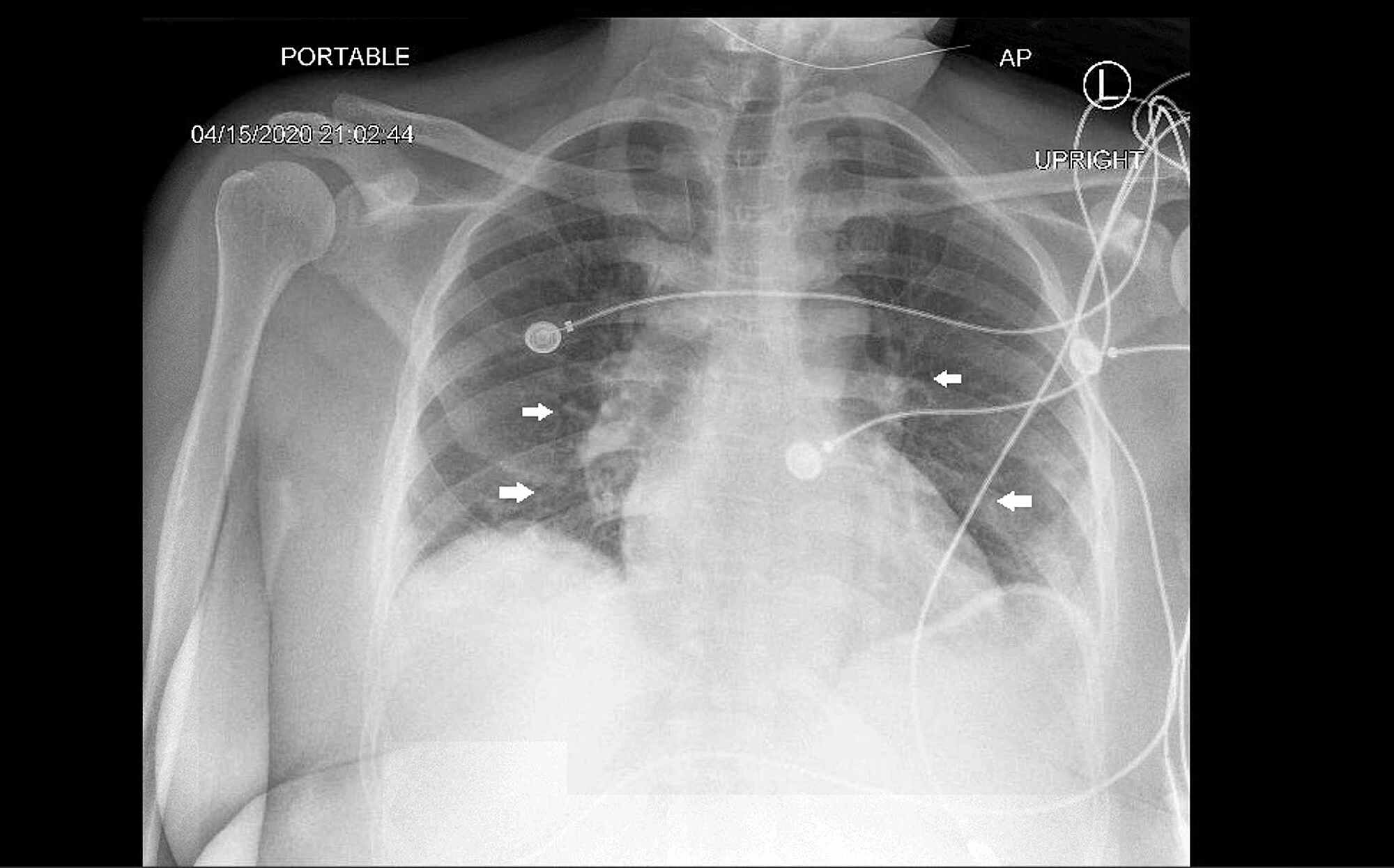 Cureus Fulminant COVID19Associated Myocarditis in an Otherwise