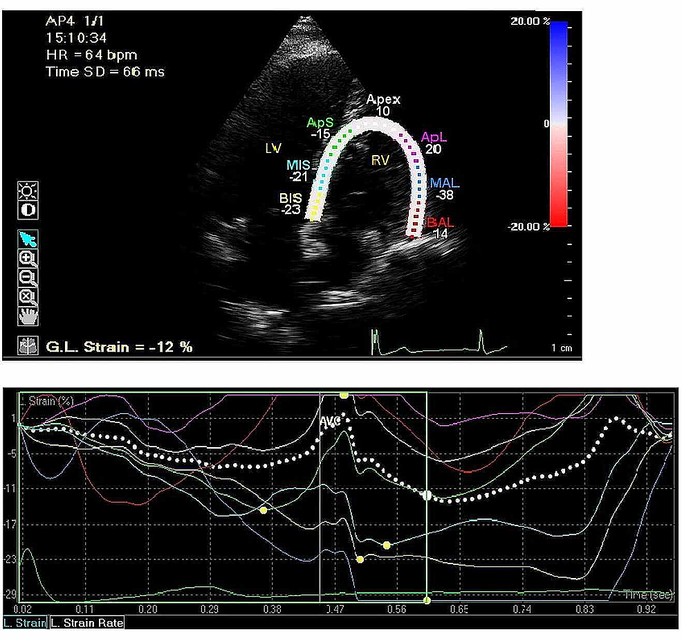 Speckle-tracking strain echocardiography: Any place in routine daily  practice in 2014?
