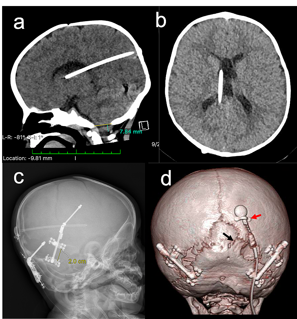 Cureus | Management of Pre-existing Ventriculoperitoneal Shunt in ...