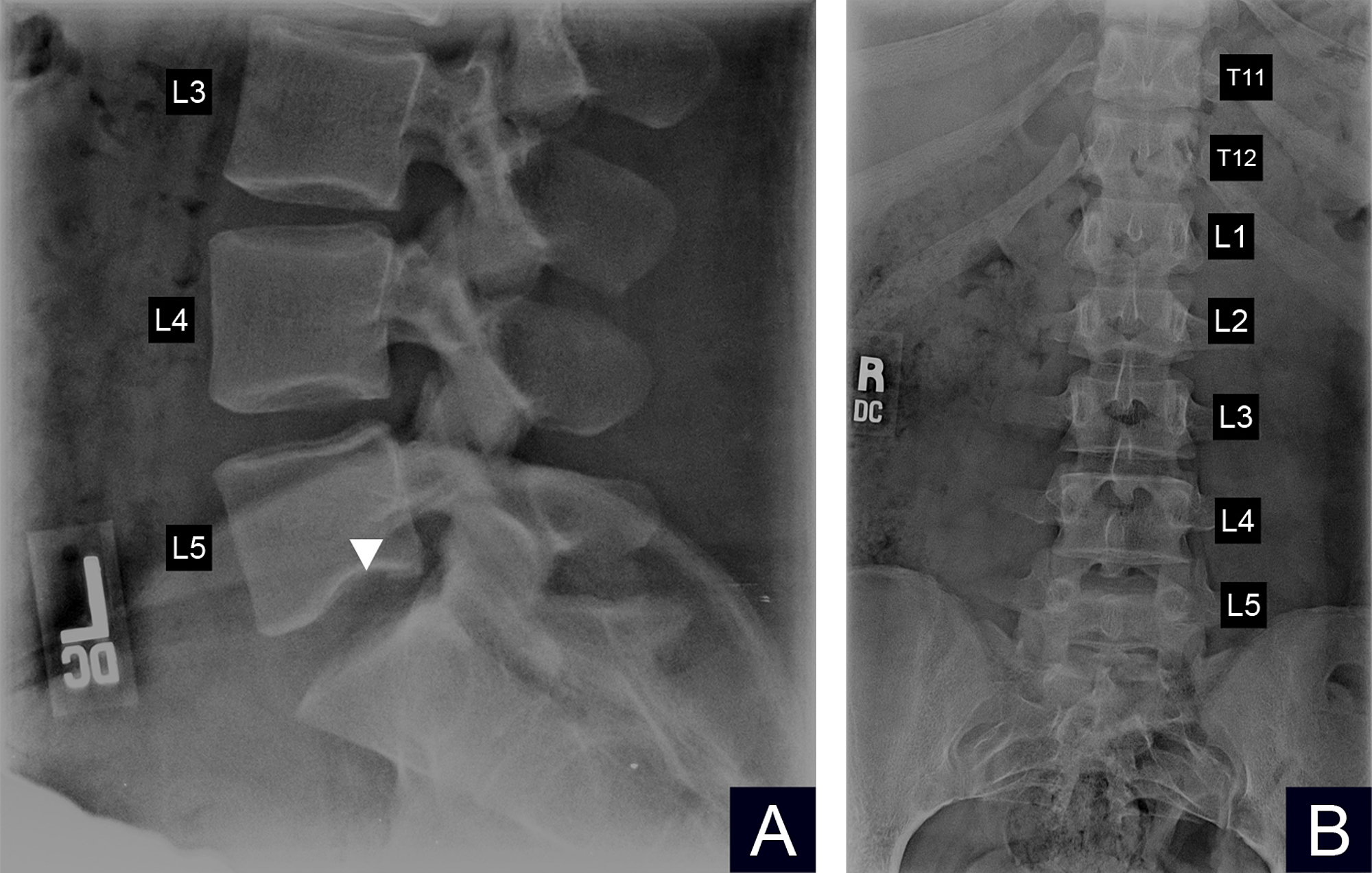 Cureus | A Case of Persistent Low Back Pain in a Young Female Caused by