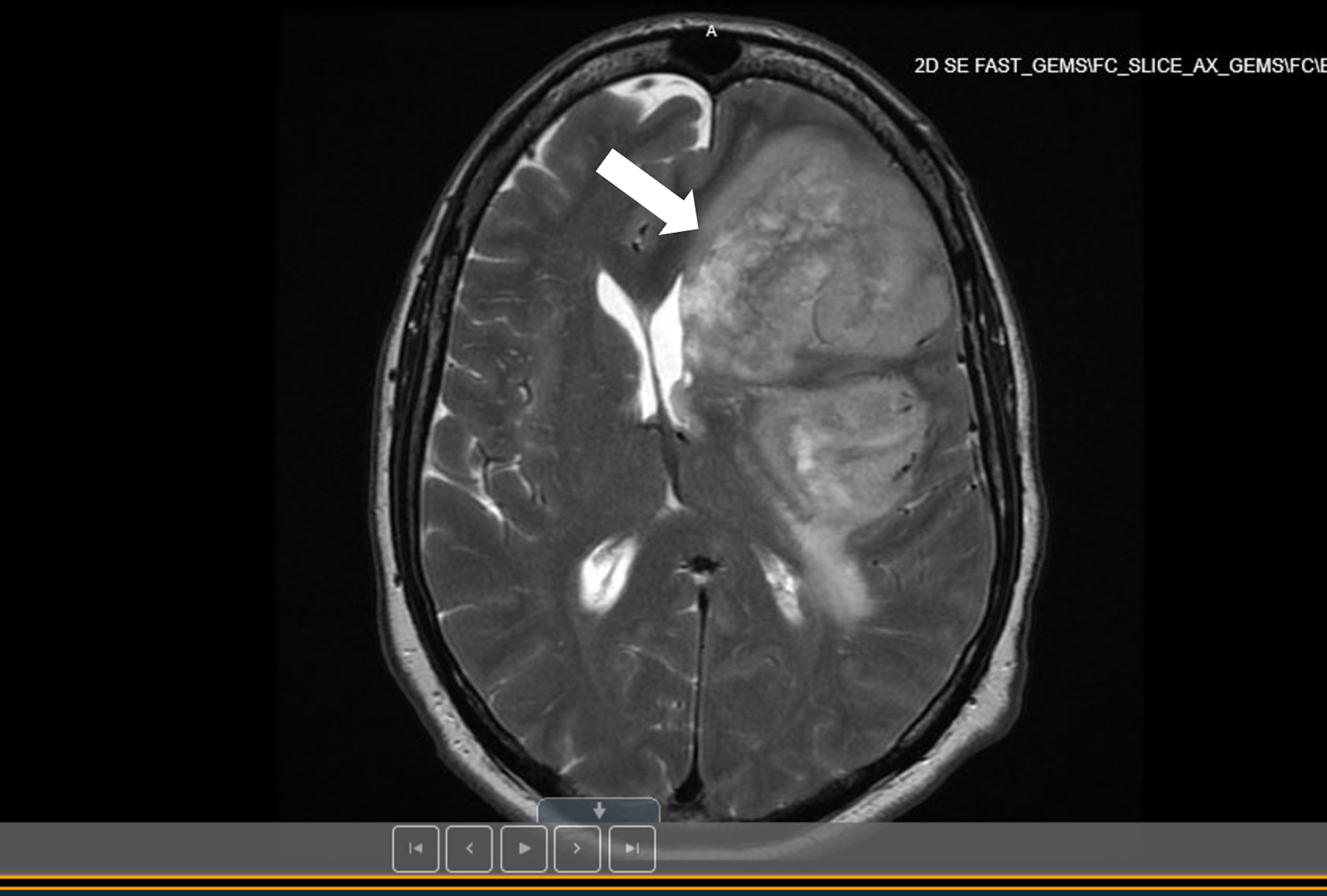 Cureus | Ischemic Stroke After Tumor Resection in a Patient With  Glioblastoma Multiforme