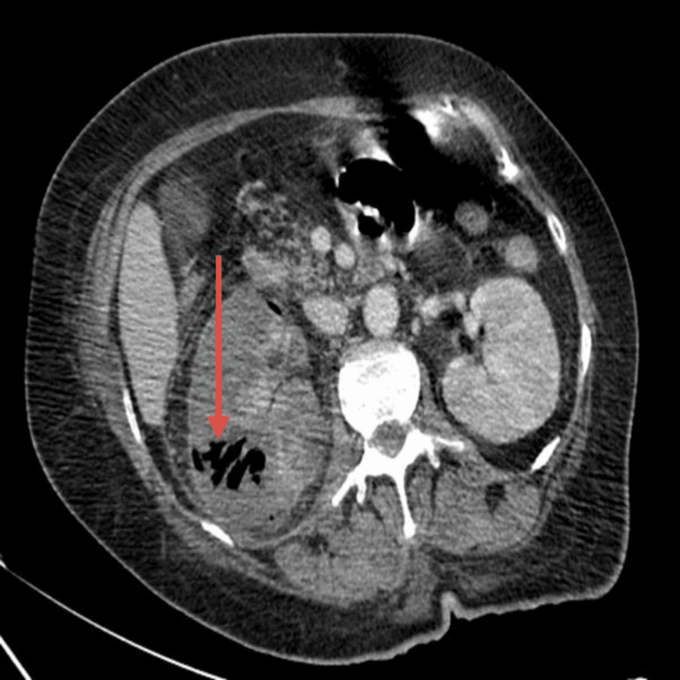 Tuberculosis Overview: Symptoms, Treatment and Causes | Apollo, image size:986x986