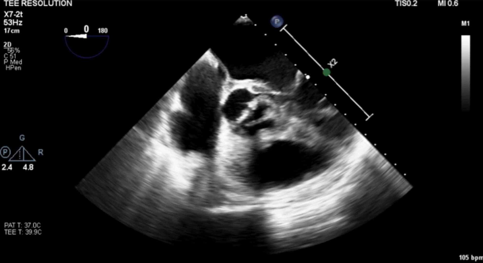 Cureus | The Value of Screening for Bicuspid Aortic Valve in First ...