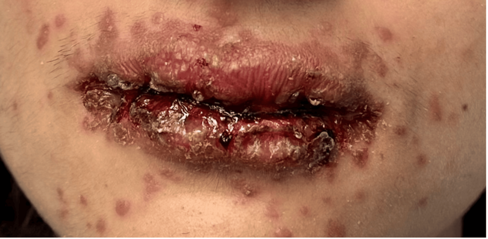 Reactive Infectious Mucocutaneous Eruption Following Isolated Rhinovirus Infection: Clinical Presentation and Treatment Response