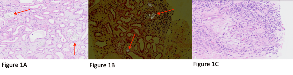 Acute Kidney Injury Secondary to Vitamin D Intoxication: A Case of Oxalate Nephropathy