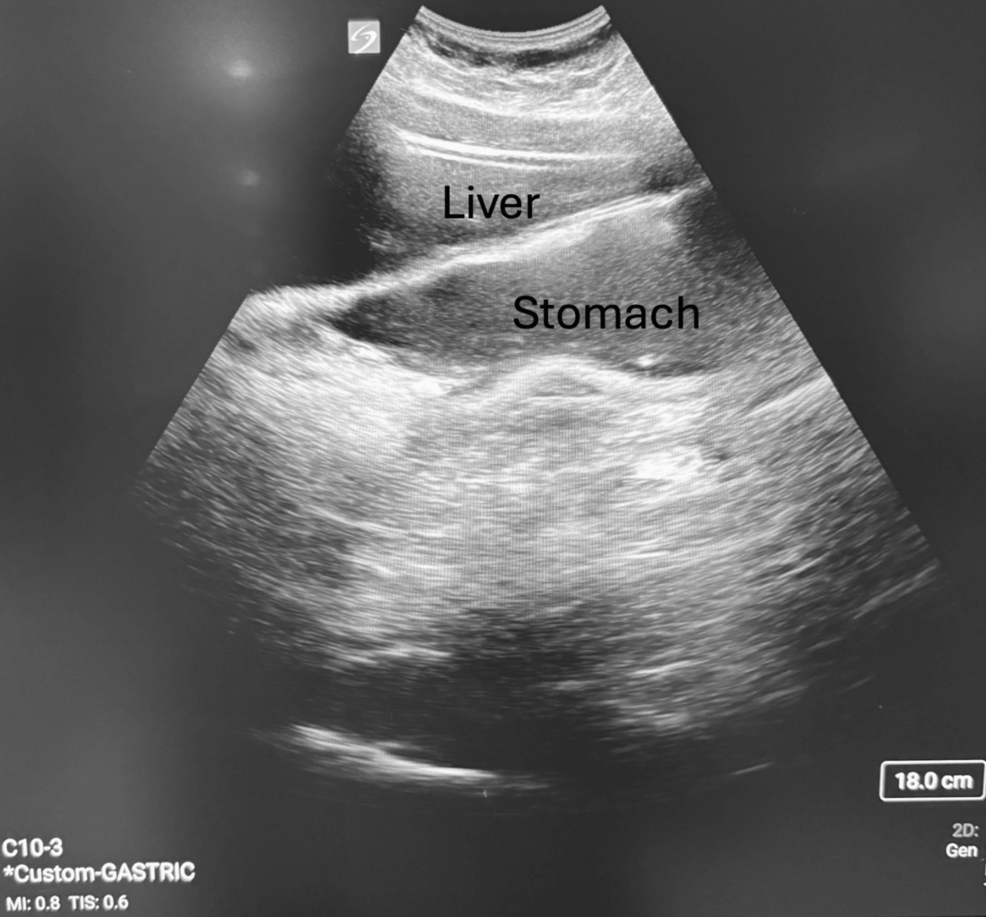 Unanticipated Residual Gastric Contents in an Appropriately Fasted Pediatric Patient on Glucagon-Like Peptide-1 Receptor Agonist Therapy: A Case Report and Review of Perioperative Considerations | Cureus Unanticipated Residual Gastric Contents in an Appropriately Fasted Pediatric Patient on Glucagon-Like Peptide-1 Receptor Agonist Therapy: A Case Report and Review of Perioperative Considerations | Cureus