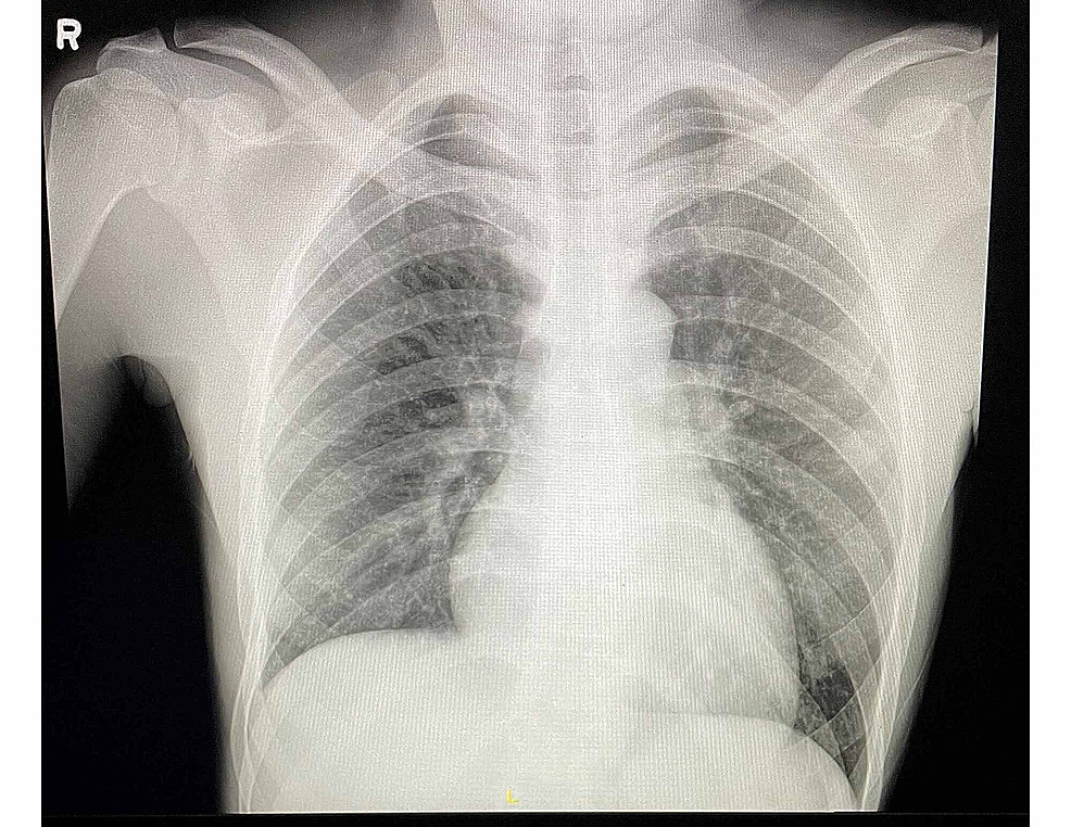 An Atypical Presentation of Lemierre’s Syndrome: Complicated by ...