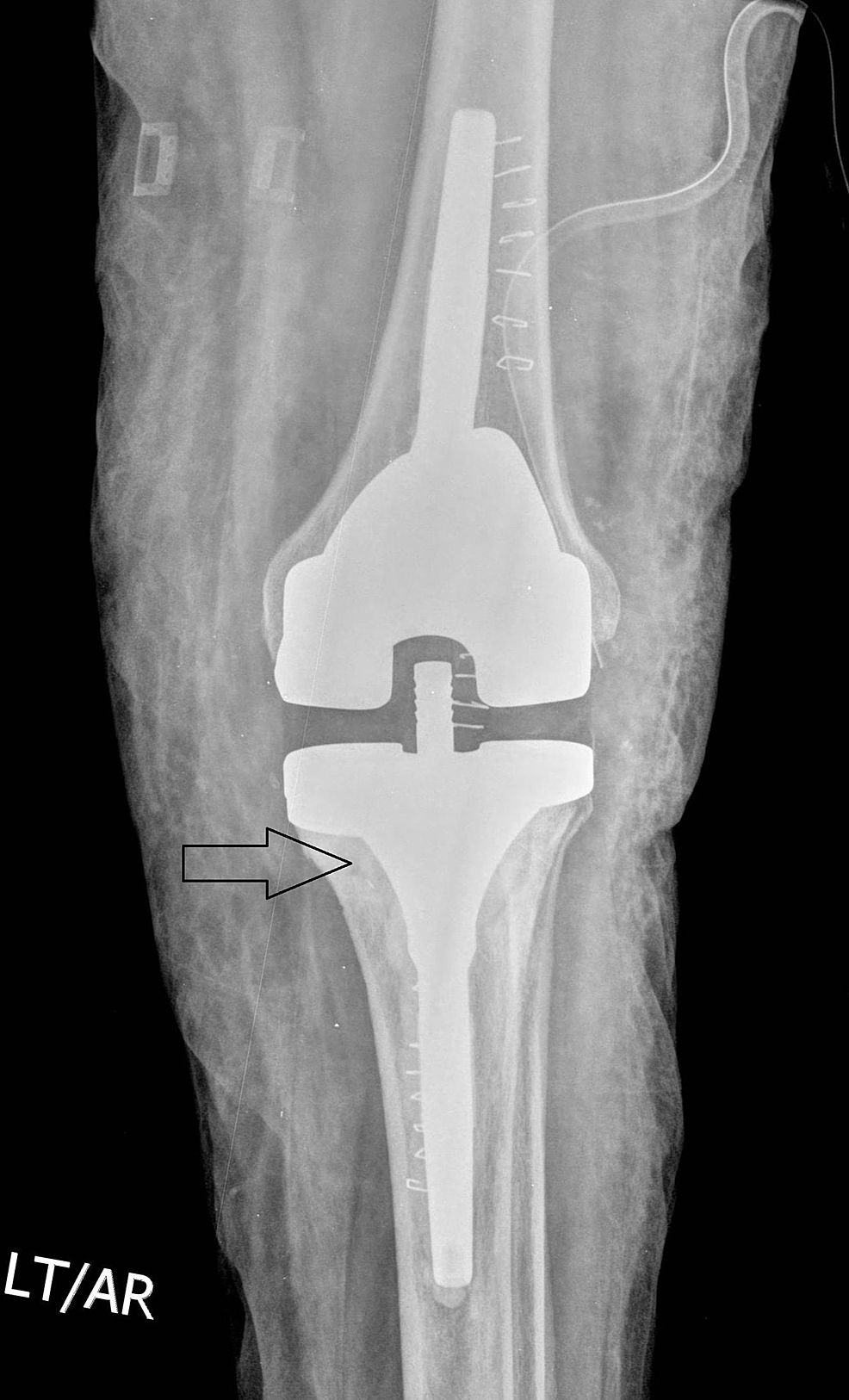 Is Single-stage Revision Safe Following Infected Total Knee ...