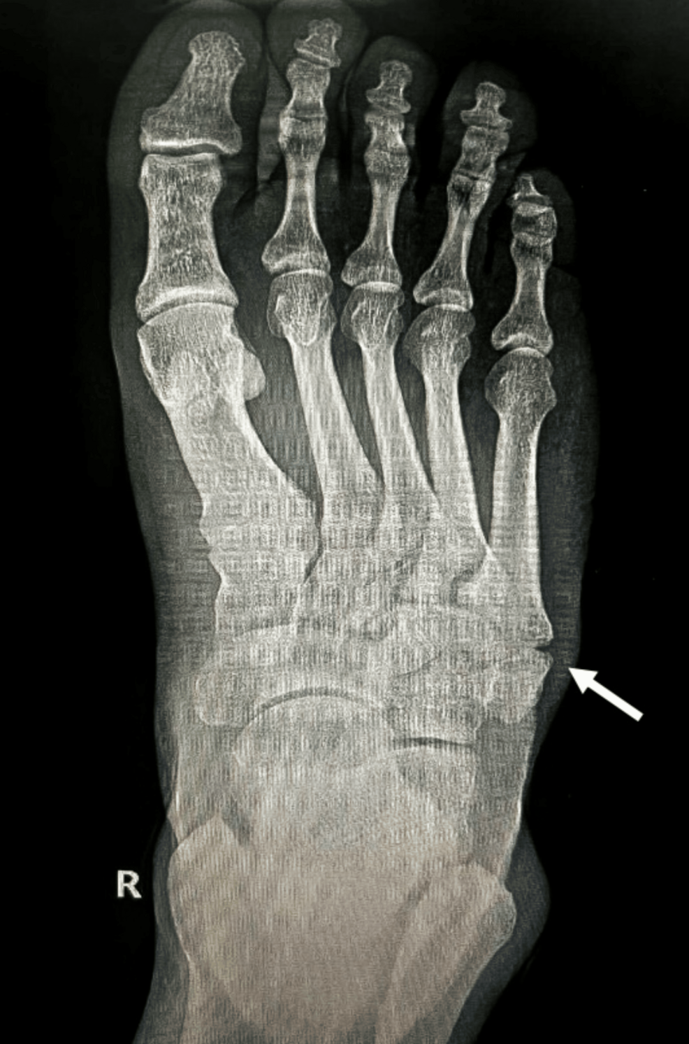 Base of the Fifth Metatarsal: Fracture or Anomaly? | Cureus, image size:986x1492