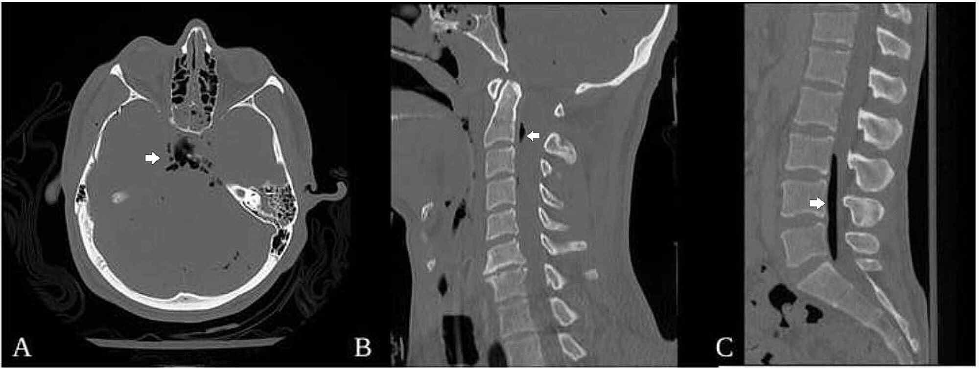 Cureus Lumbar Pneumorrhachis Associated With Basilar Skull Fractures