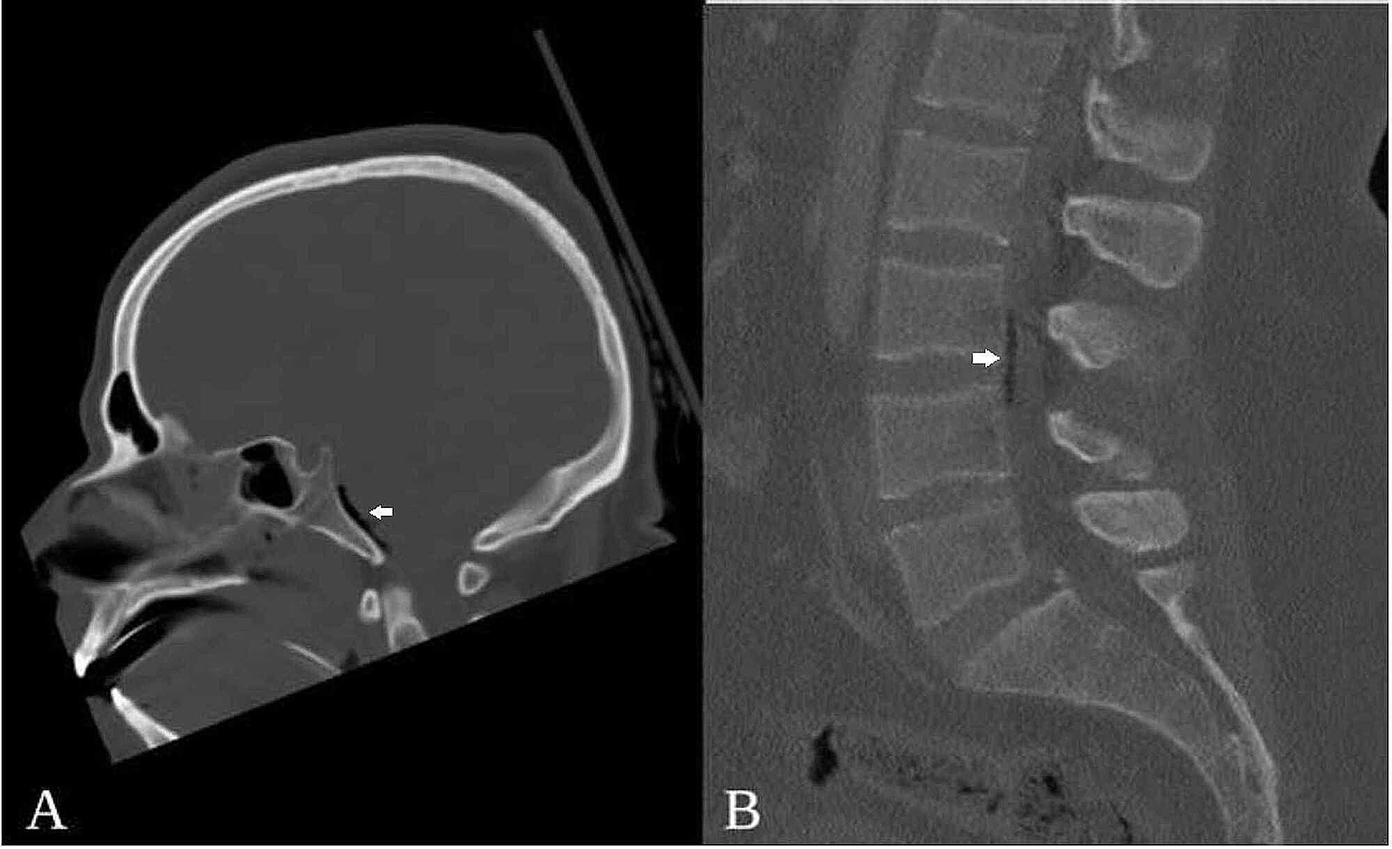 Cureus Lumbar Pneumorrhachis Associated With Basilar Skull Fractures