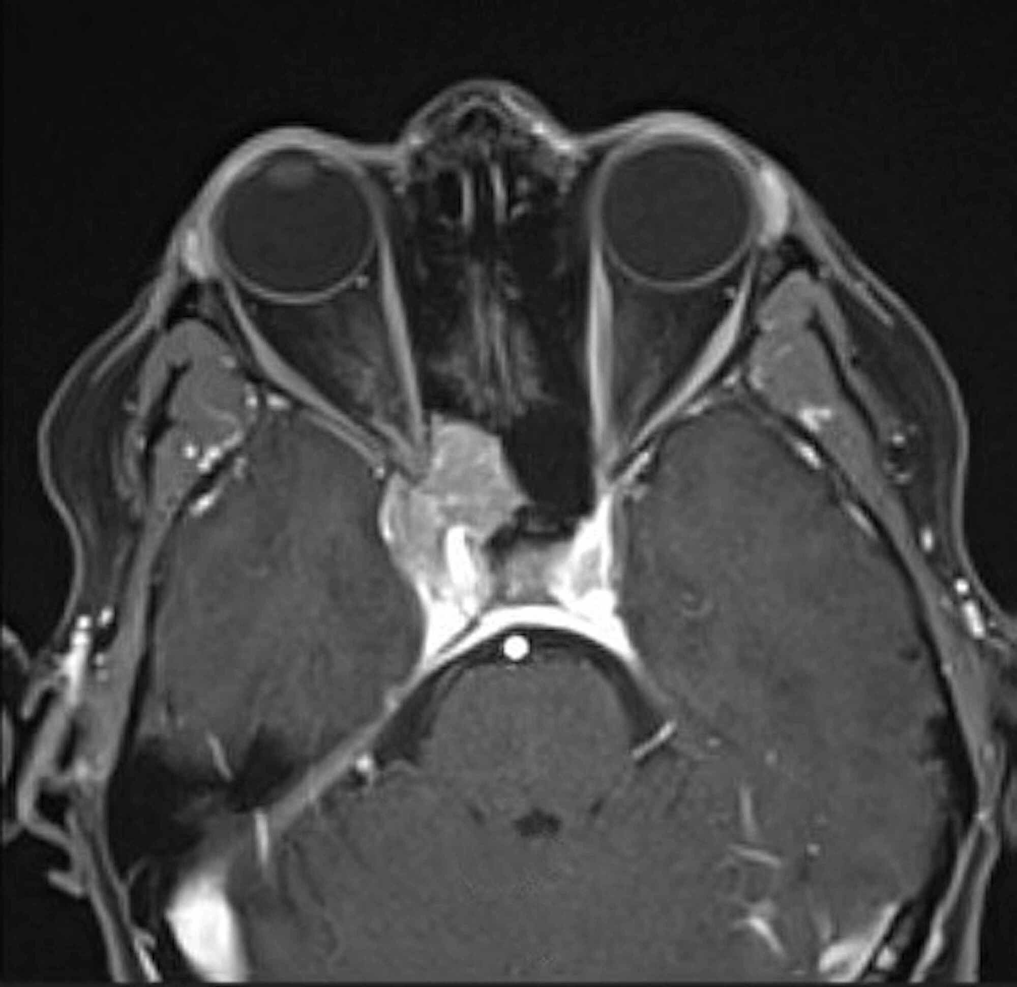Cureus Intracranial Plasmacytoma Mimicking a Cavernous Sinus Meningioma