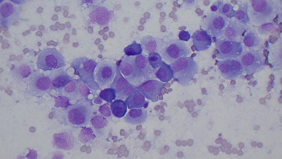 Cureus | Intracranial Plasmacytoma Mimicking a Cavernous Sinus Meningioma