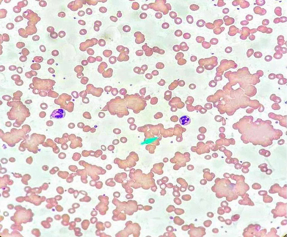 Peripheral-blood-smear-at-7-degree-Celsius