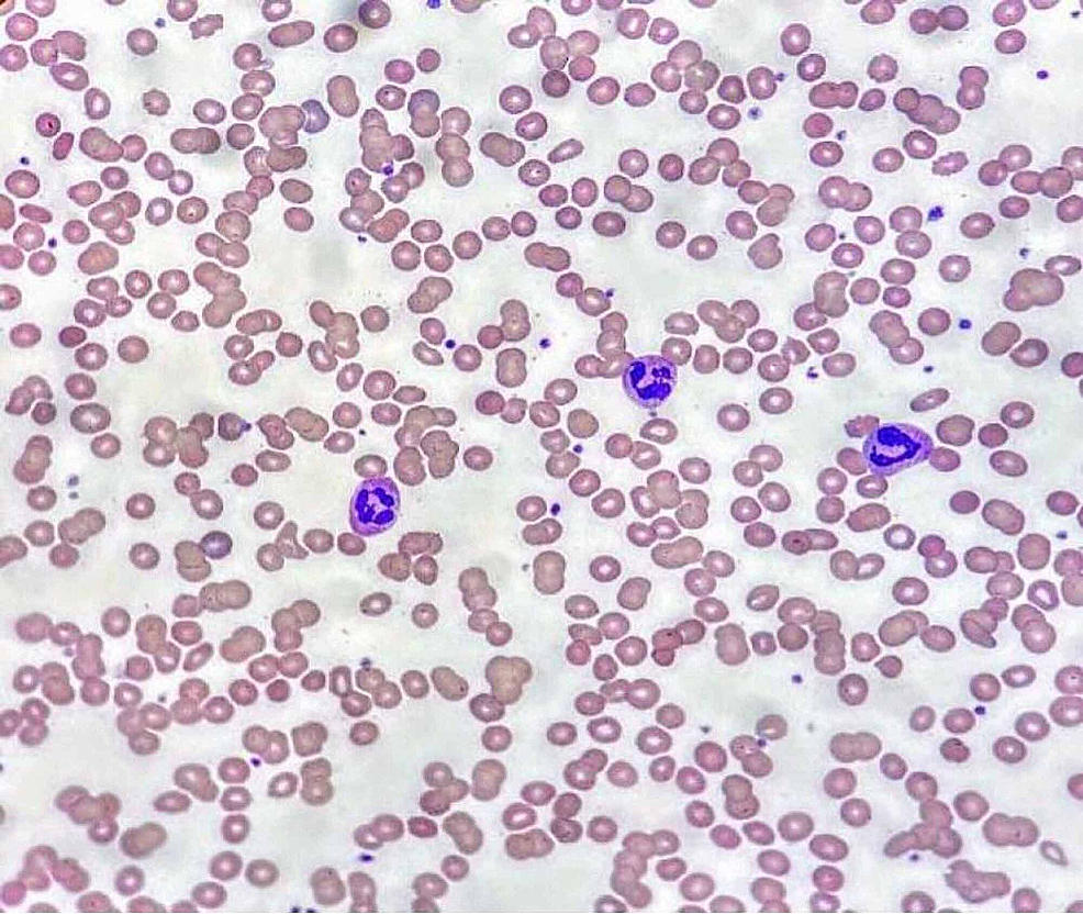 Cureus | Transient Cold Agglutinins in a Patient With COVID-19