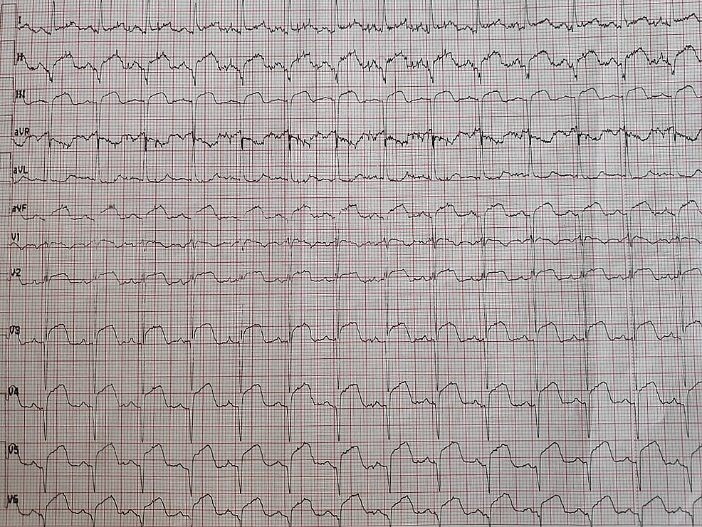 Electrocardiogram-showing-ST-segment-elevation-in-all-leads,-except-aVR-where-ST-segment-depression-was-noted