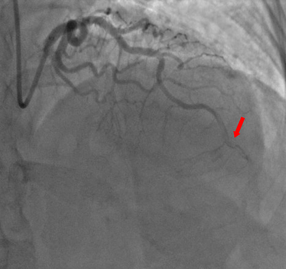 Coronary-angiography-showing-an-extended-thrombus-in-the-distal-segment-of-the-left-anterior-descending-artery-(LAD)