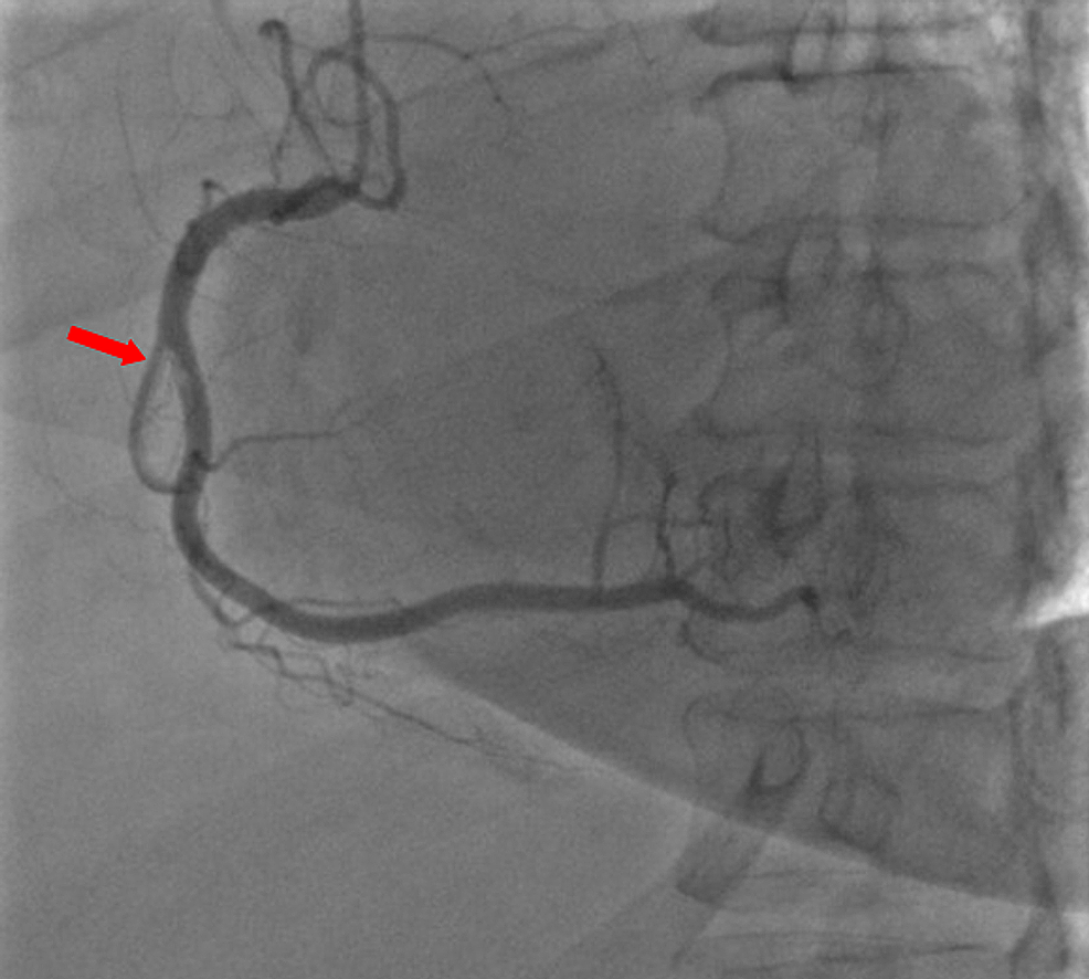 Coronary-angiography-showing-a-thrombus-in-the-second-segment-of-the-right-coronary-artery-(RCA)