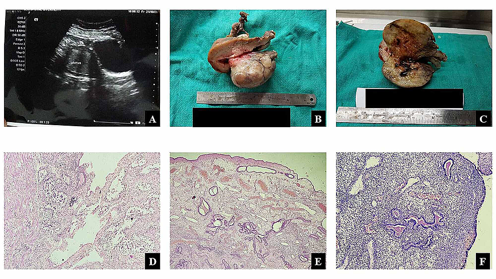 Cureus Giant Endometrial Polyp in a Postmenopausal Woman Cureus Giant Endometrial Polyp in a Postmenopausal Woman