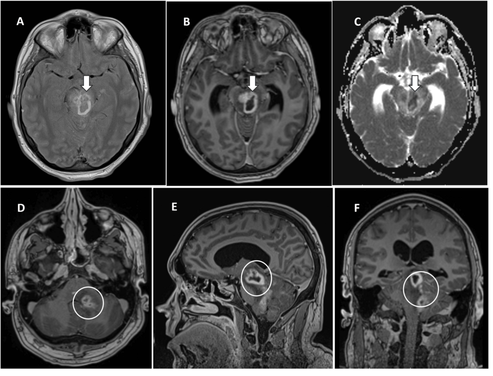 Neurolisteriosis in an Immunocompetent Adult Patient