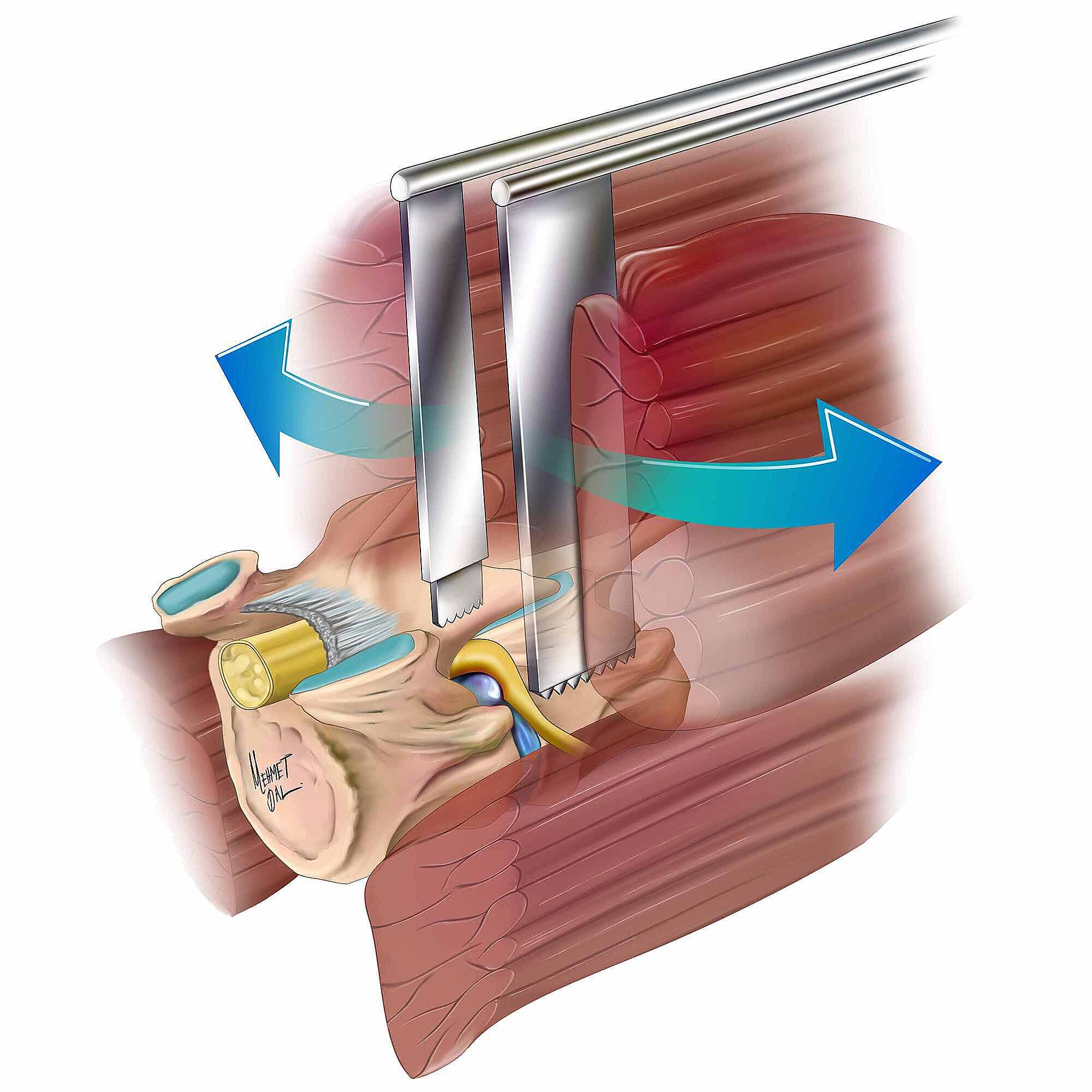 Cureus Minimally Invasive Far Lateral Microdiscectomy A New Retractor For Far Lateral Lumbar 8601