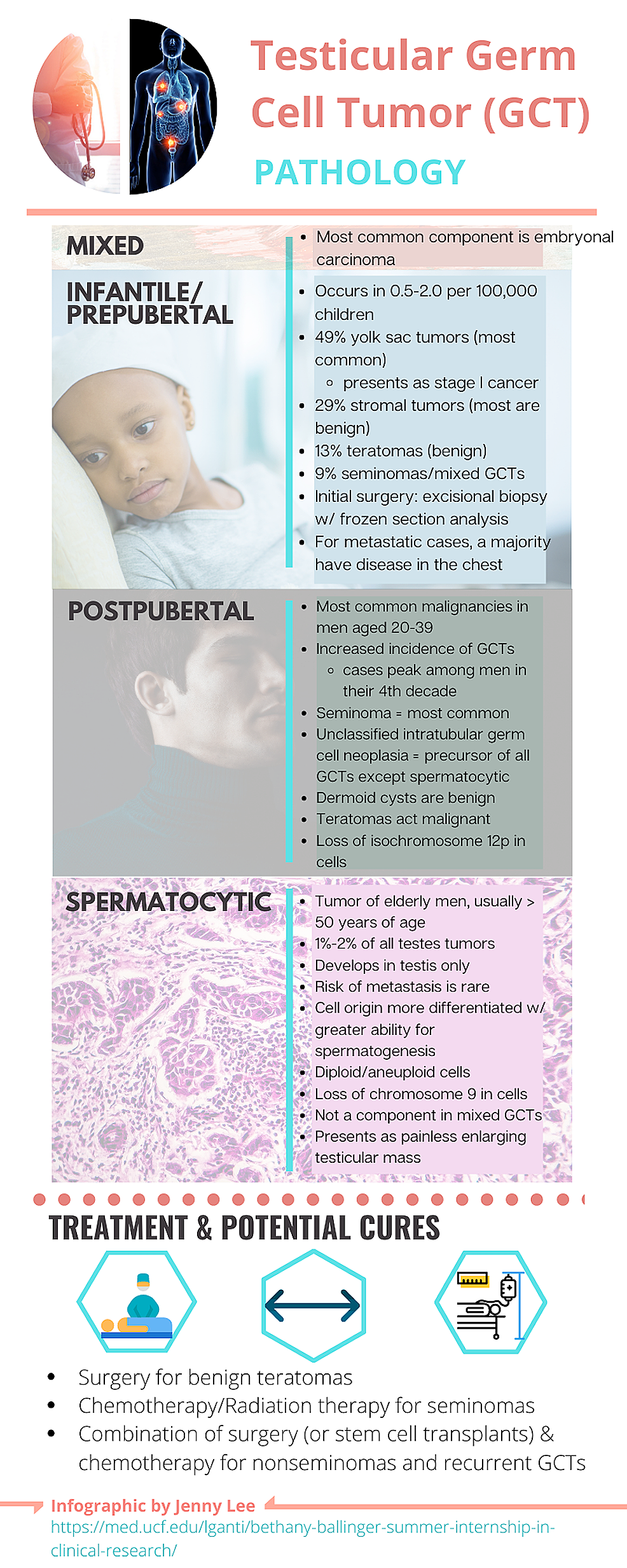 Cureus Testicular Germ Cell Tumor Presenting to the Emergency Department