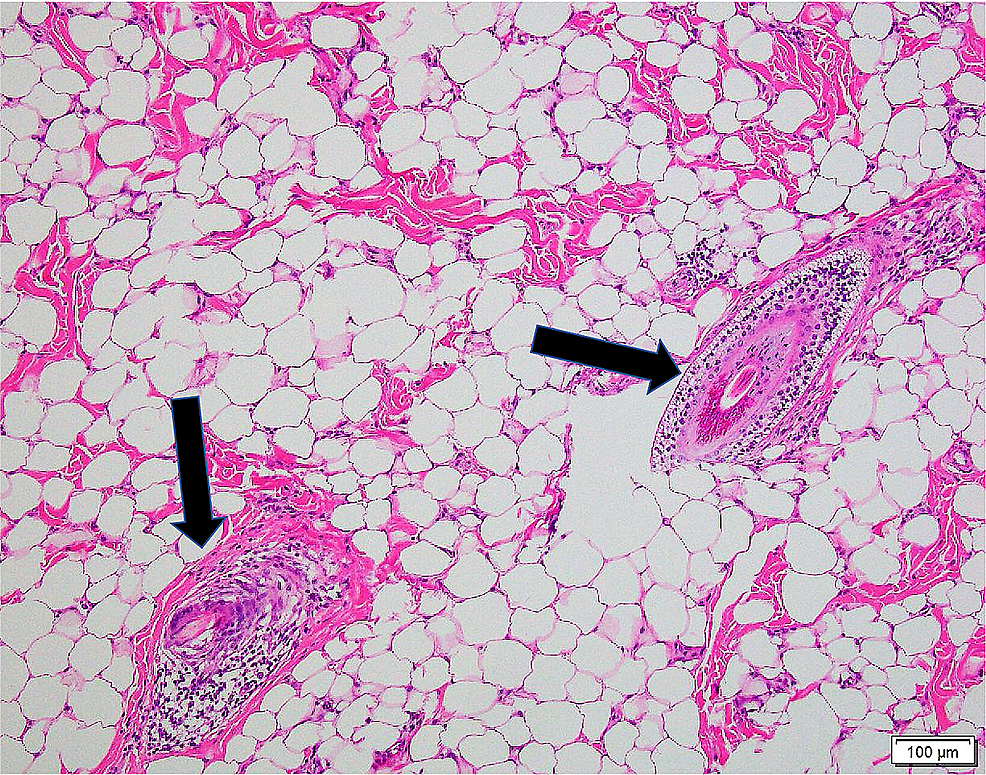 Cureus A PostAuricular Accessory Tragus