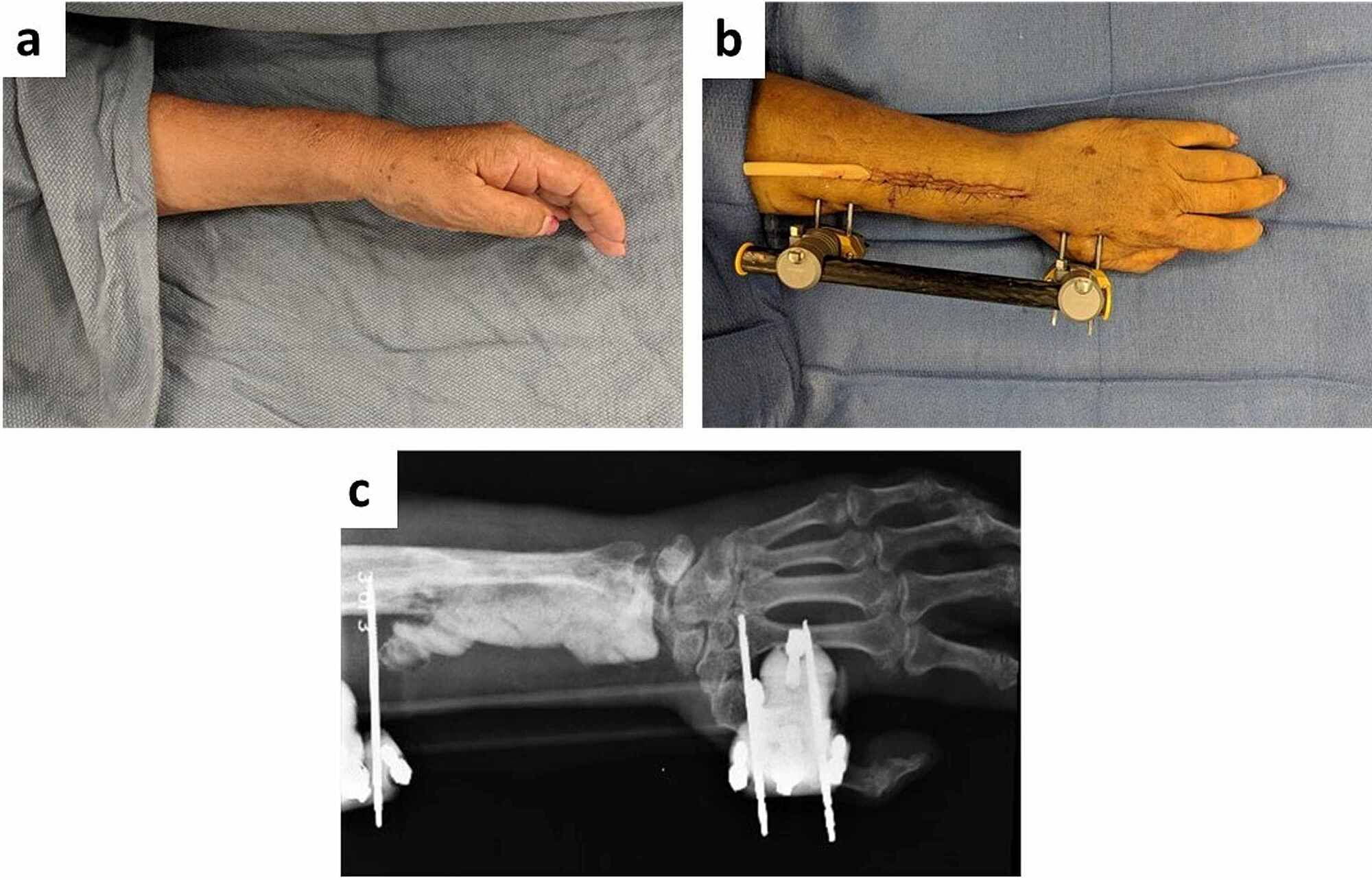 Distal Radius External Fixator