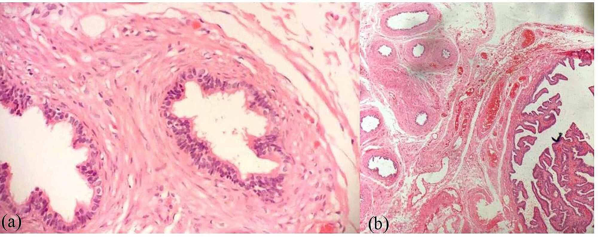 Cureus Mosaic Turner Syndrome With 45,X/46,XY Mosaicism and Apparent
