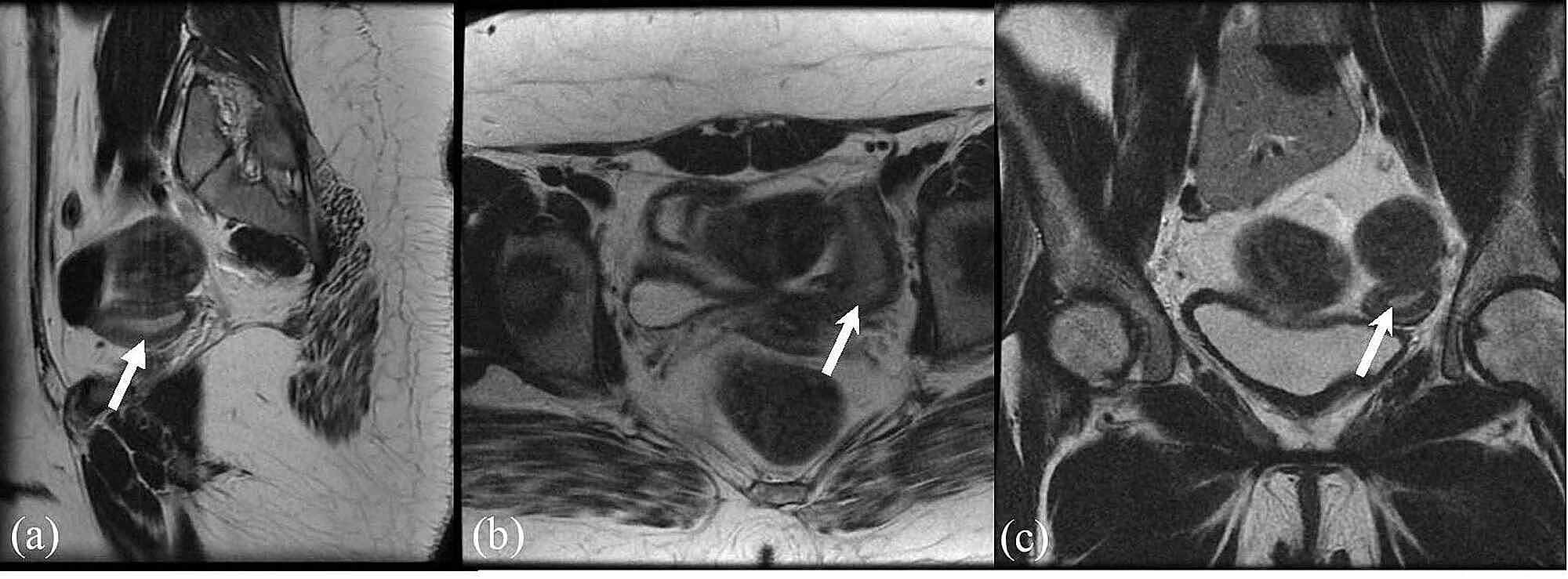 Cureus Mosaic Turner Syndrome With 45,X/46,XY Mosaicism and Apparent