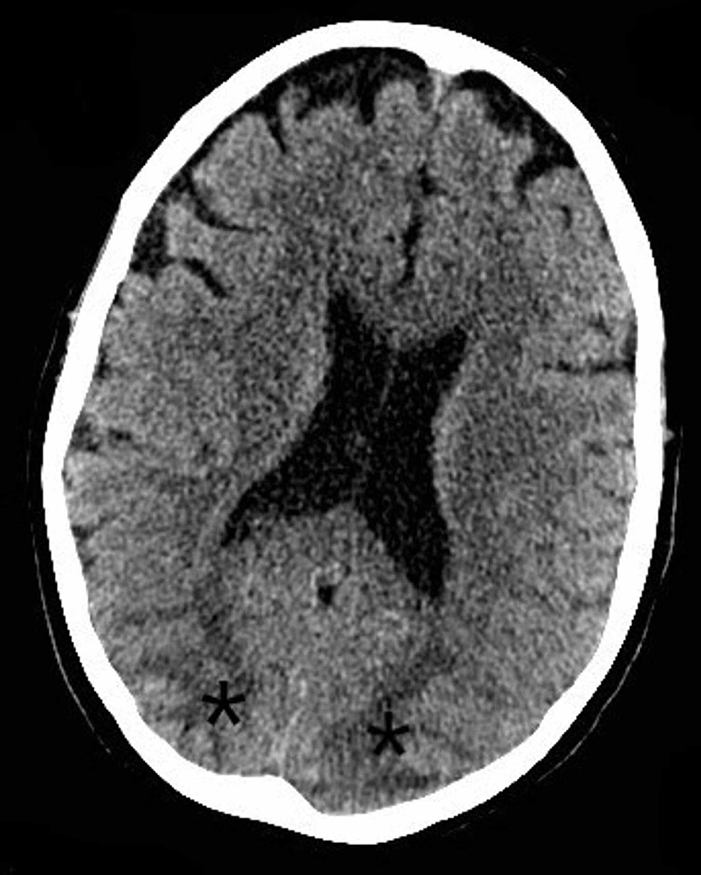 CT-scan-of-the-head-showing-evidence-of-relative-hypodensities-(marked-with-asterisks)-suggestive-of-posterior-reversible-encephalopathy-syndrome-(PRES)