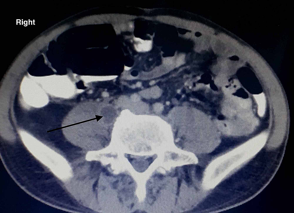 Cureus | Chronic Undiagnosed Brucellosis Presenting as Sciatica